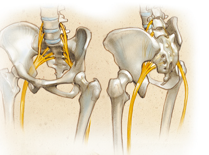 Chiropractic treatment of sciatica